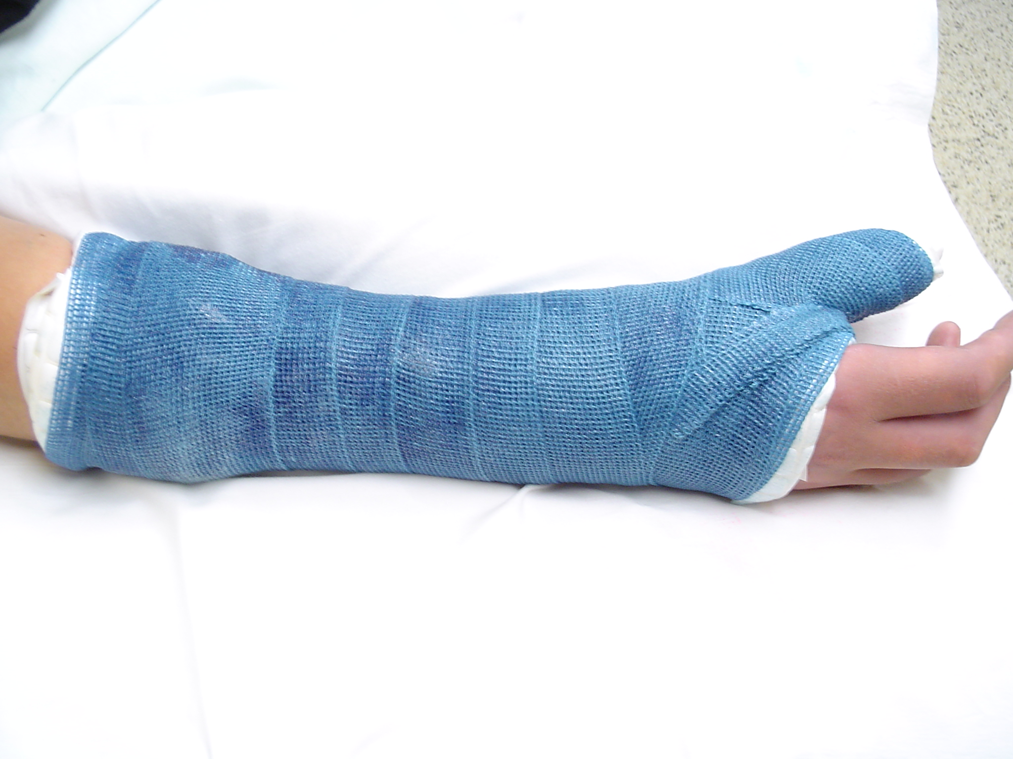 Thumb Spica Cast
