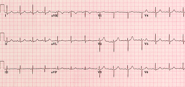 Ecg Chart Analysis