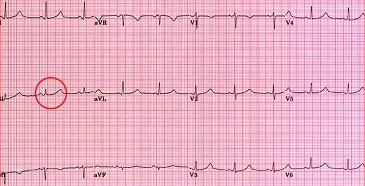 Prolonged QT Interval
