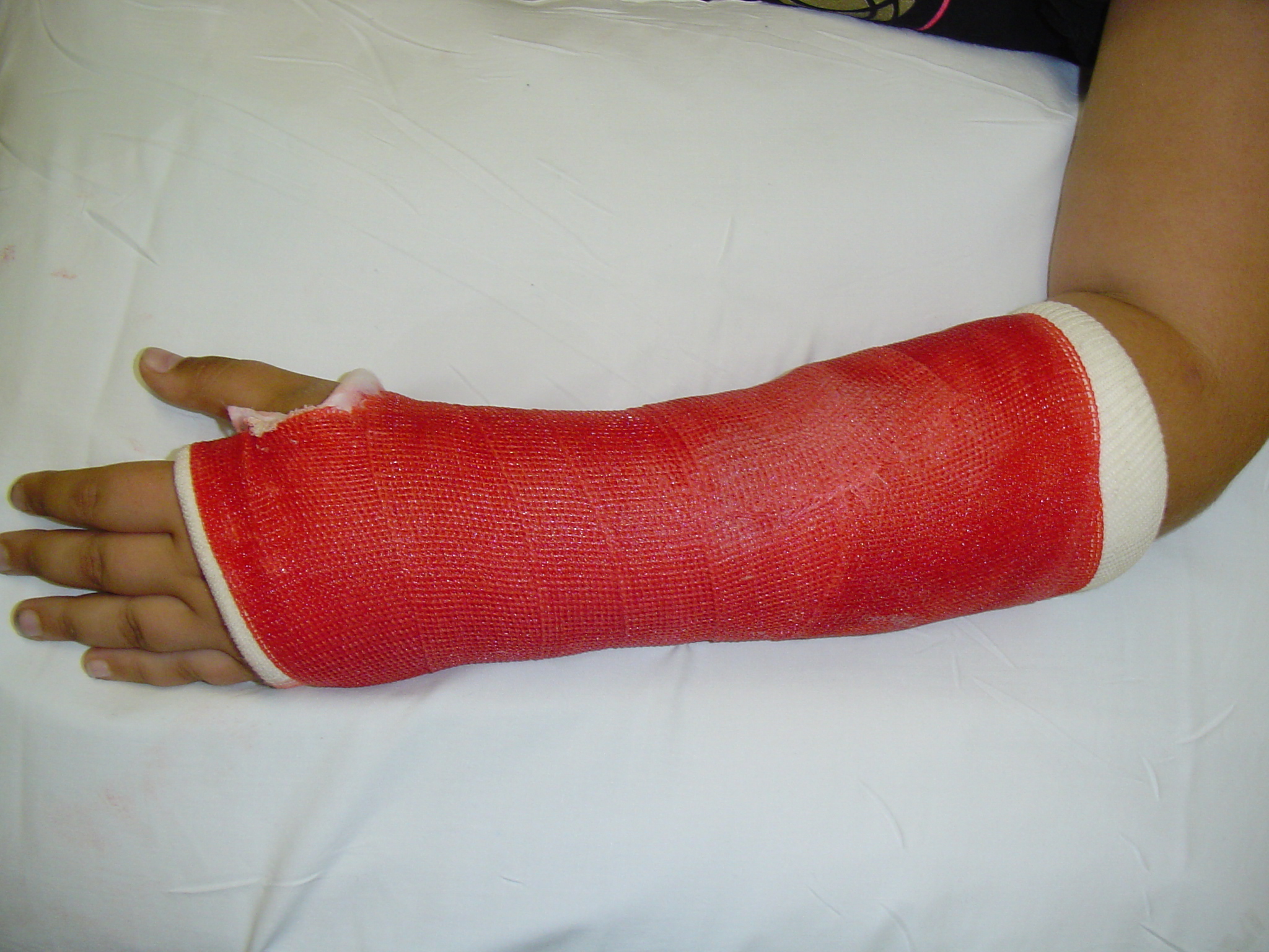 Arm cast online