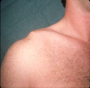 Clinical-picture-shoulder.gif