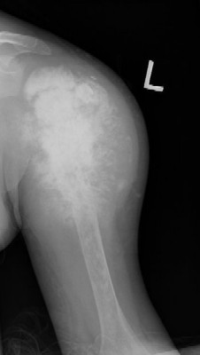 This child has an agressive humeral osteosarcoma.  The sunburst reactive bone formation shown in this image is growing so rapidly that there is not enough time for a layer of bone to form over the periosteum. This is indicative of an aggressive growth and suggests, albeit not conclusively, the presence of a malignancy. In this case, the sunburst pattern is caused by an osteosarcoma.