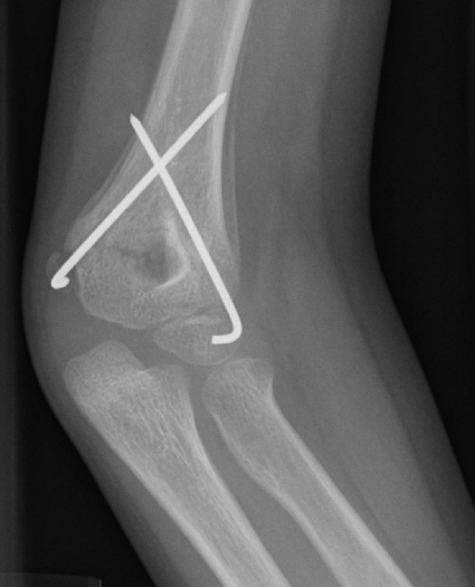 This is an example of benign periosteal reaction seen as a normal part of fracture healing in a child four weeks after a supracondylar humeral fracture