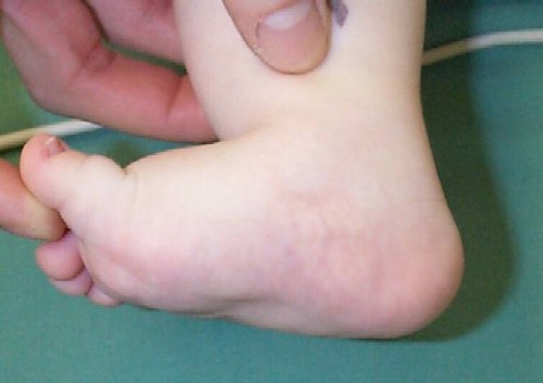 Newborn Baby Foot Problems and Deformities