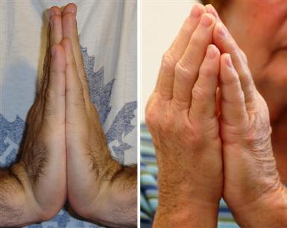 Prayer Sign - A negative prayer sign is shown on the left, and a positive is on the right.  Note how in a positive sign the patient is unable to keep thier palms flat against one another.