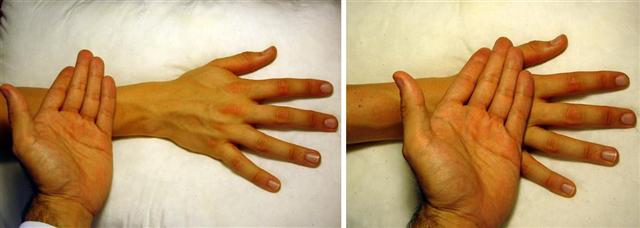 Inflammation in a joint will cause the overlying skin to be noticeably warmer than the forearm.