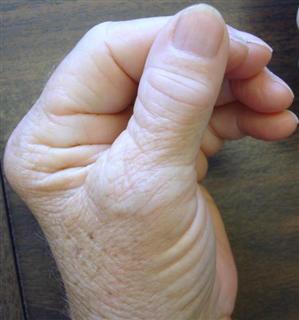 It is common for patients with arthritis to be unable to make a closed fist.