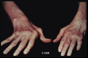 Chronic inflammation of the small joints in the hand have led to a characteristic RA pattern of deformity (©ACR www.rheumatology.org)