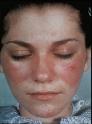 Malar rash in patient with SLE (©ACR www.rheumatology.org)