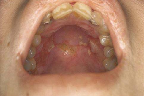 Mouth ulcers in patient with SLE (©ACR www.rheumatology.org)