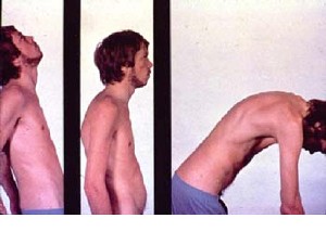 Young man with ankylosing spondylitis. (courtesy Dr. I. Dwosh)