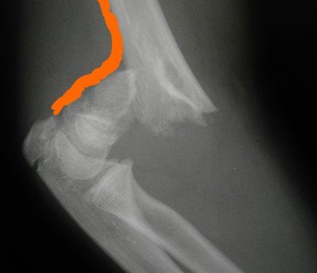 The intact posterior periosteal hinge in this supracondylar humeral fracture will help achieve a satisfactory closed reduction in this child. If the posterior periosteum is torn (as it is anteriorly) the fracture will be much more unstable and may require open reduction.  