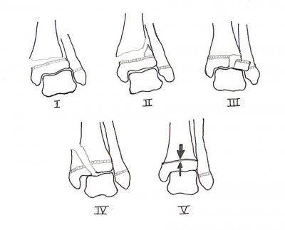 The Salter-Harris classification of growth plate injuries.