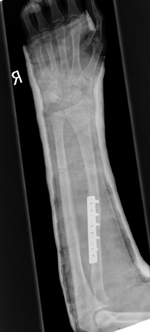 Osteotomy of the ulna has corrected the plastic deformation.  Normal range of motion of the forearm is restored.