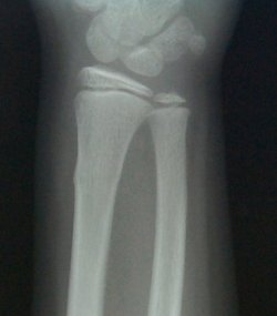 This three year old girl fell on her outstretched left arm while playing at daycare. Caregivers noted that she cried immediately and was reluctant to use the hand and arm normally for the rest of the day. This xray was done 24 hours later when her symptoms failed to resolve. 