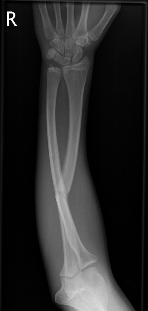 Angulated fracture of forearm with distal ulnar plastic deformation.  The ulna is usually completely straight in AP and lateral xray views.