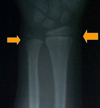 AP xray young child's wrist with physes marked