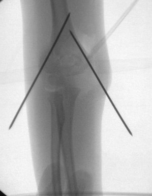 Intraoperative fluoroscopic image taken after closed reduction and pinning of fracture.