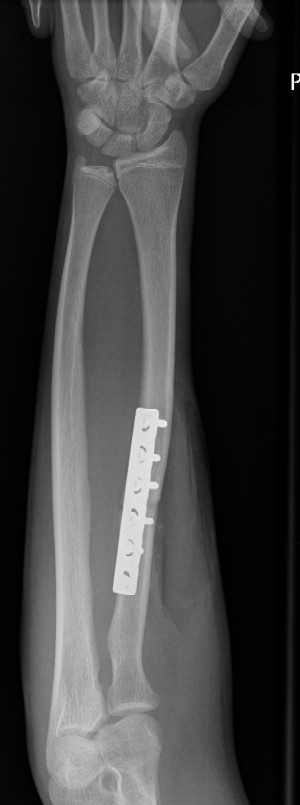 The radial fracture has been reduced and plated but the ulnar plastic deformation remains.  Pronation/supination is restricted because of an abnormal curve in the distal ulna.