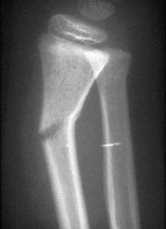 This four year old boy fell off his bicycle while learning how to ride independently. He cried immediately and was brought to the hospital for assessment. The triage nurse noted an obvious deformity at the wrist.  This xray was taken at the Emergency Room one hour after the injury. 