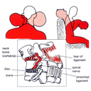 Show Whiplash Injury Image