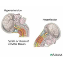 Show Types of Whiplash Image