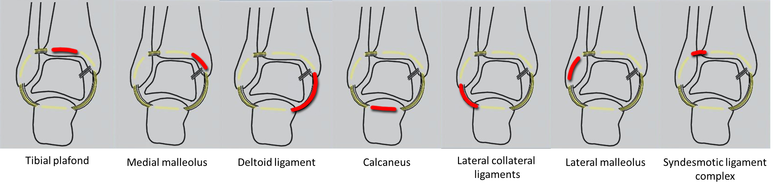 https://elentra.healthsci.queensu.ca/assets/modules/ts-ankle-radiograph/Picture12.png