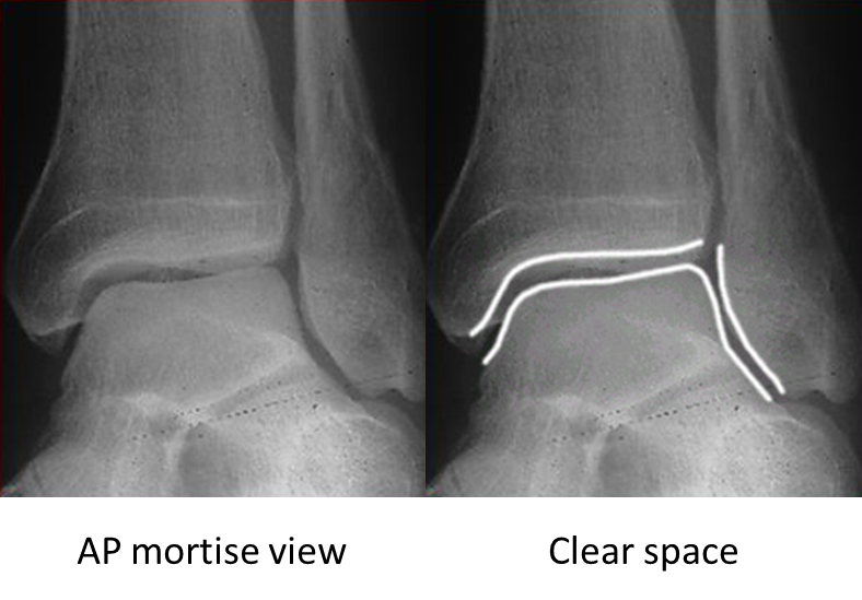 normal ankle xray ap