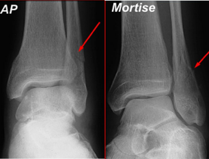 medial malleolus avulsion fracture