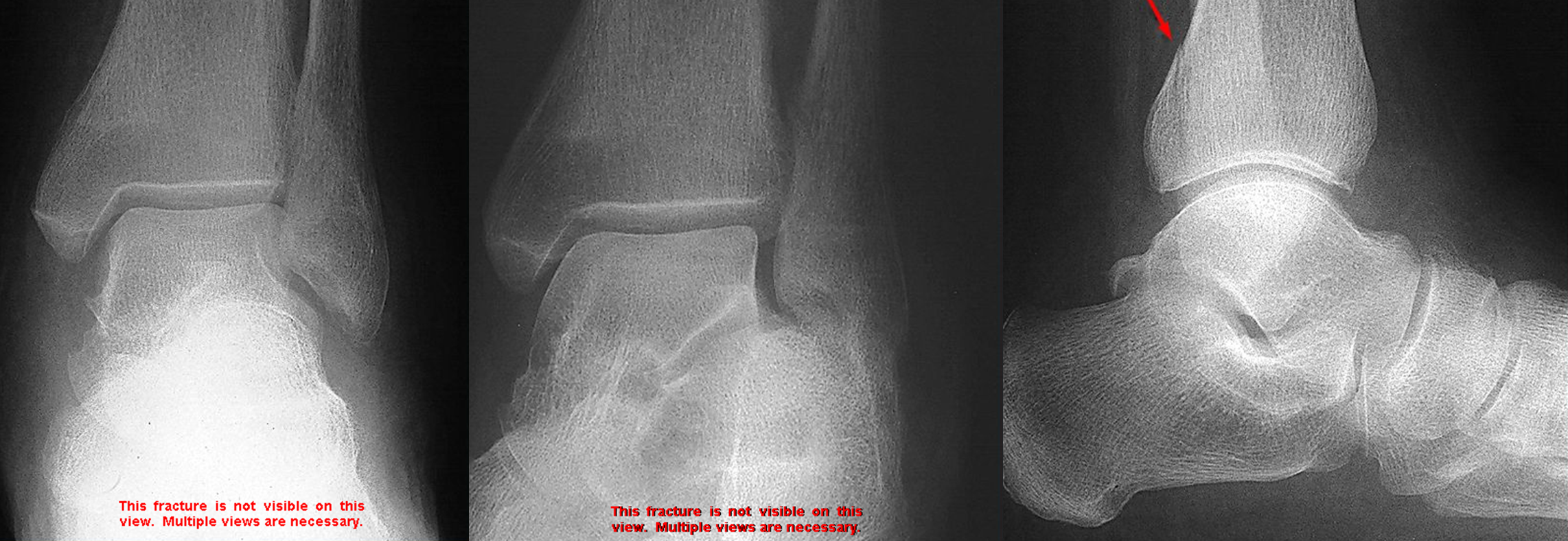 avulsion fracture ankle malleolus