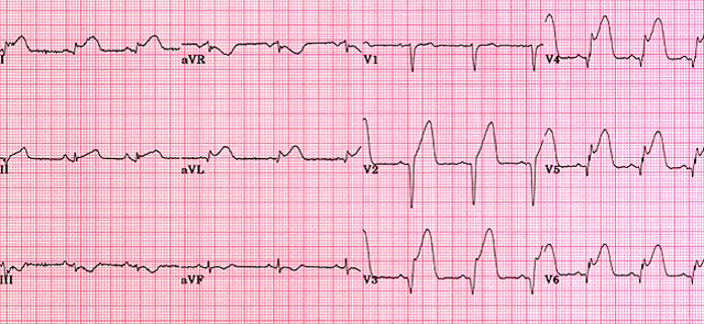 anterior myocardial infarction ecg