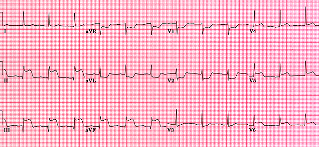 posterior-myocardial-infarction-ecg