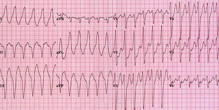 ventricular tachycardia ecg
