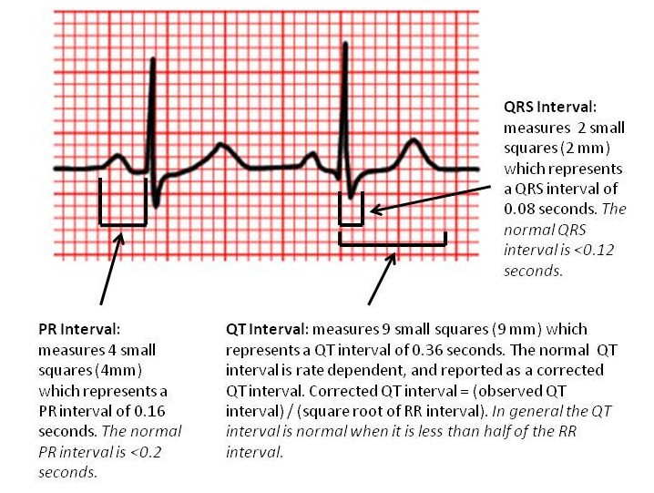 Rapid ID - EKG Intervals & Measures