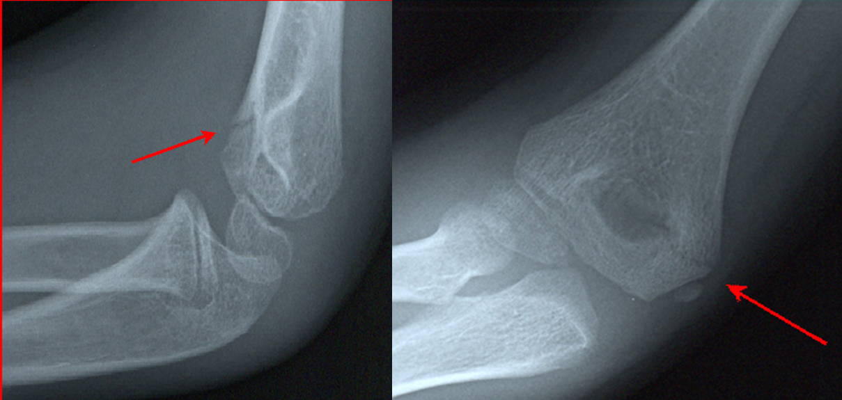 humerus fracture icd 10