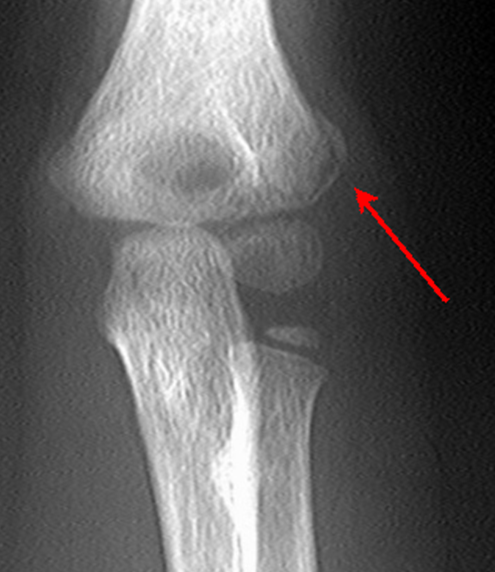 oblique humerus fracture