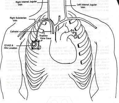 Mediport (Port) Placement