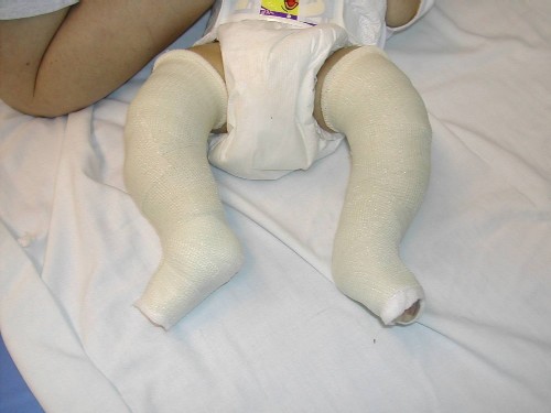 clubfoot casts.jpg