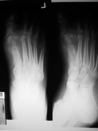 xray_foot.jpg