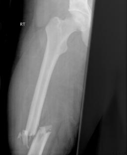 femur1.jpg