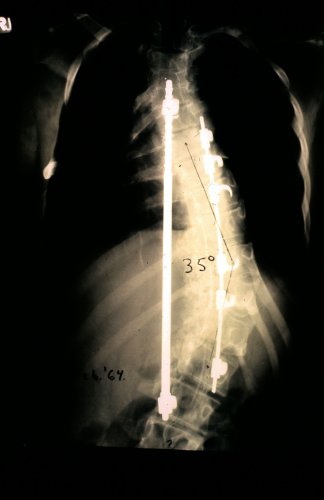 scoliosis.jpg