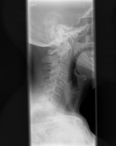 Cervical_spine_Xray.jpg
